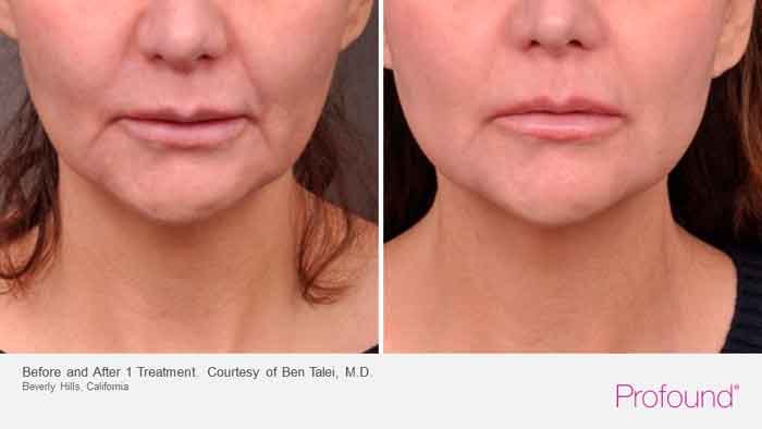 Before and after Profound Microneedle treatment