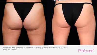 Profound treatment on butt - before and after 2 months